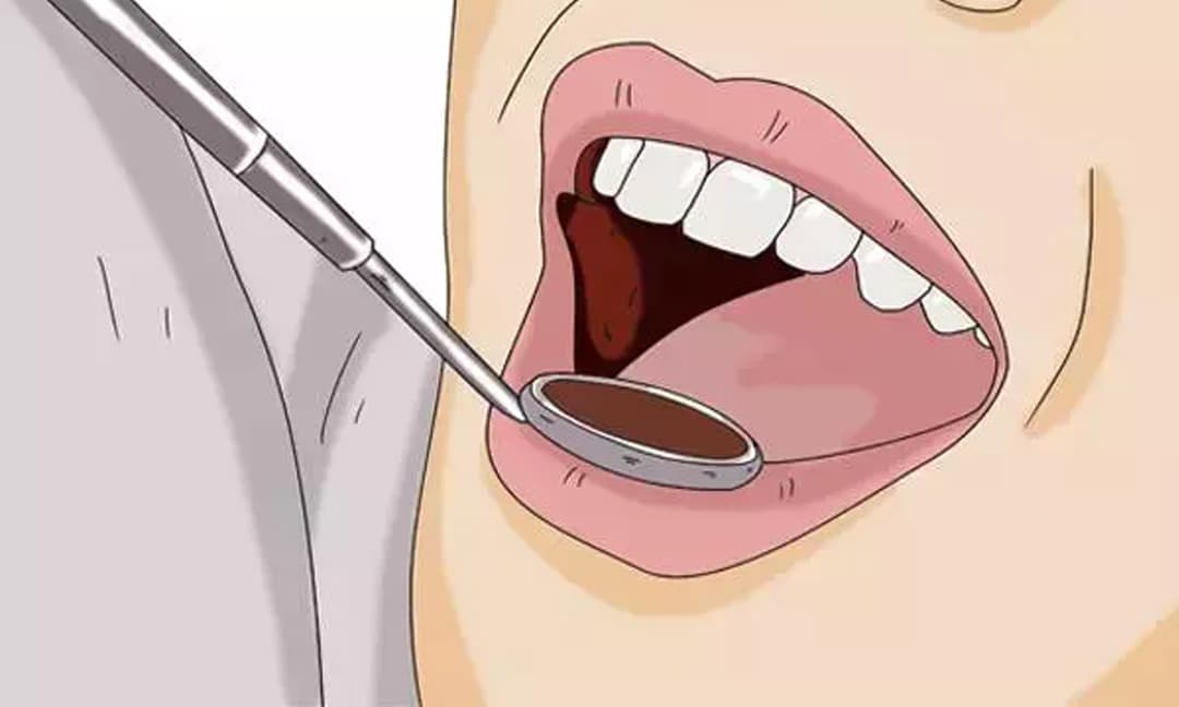Có đốm đen trên răng, có phải sâu răng không? 3 hiểm họa lớn do vôi răng gây ra, cách giải quyết?